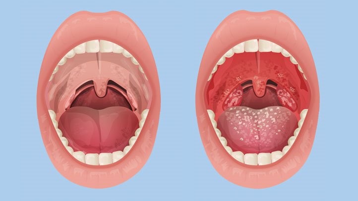 टन्सिल निको बनाउन अपनाउनुस् यी घरेलु उपाय