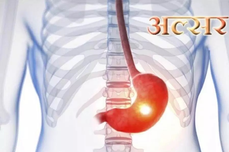 खेलाँची नगरौँ भयानक बन्न सक्छ पेटको अल्सर