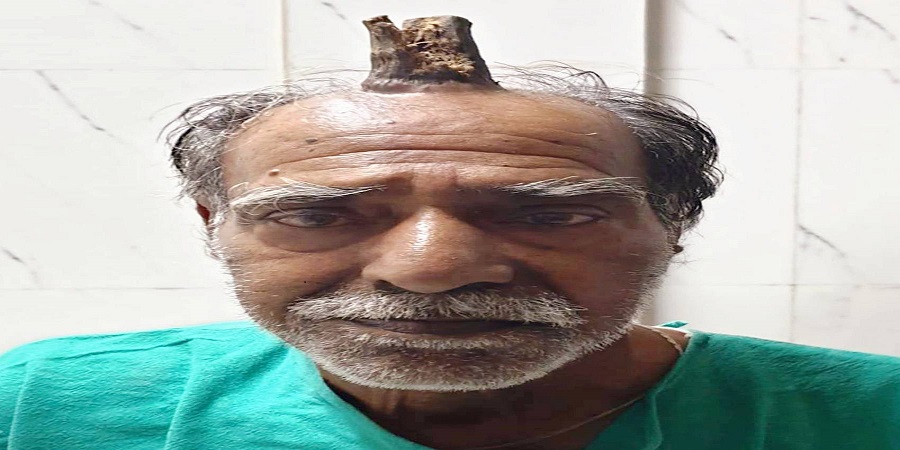 मानिसको टाउकोमा सिंङ पलाएपछि